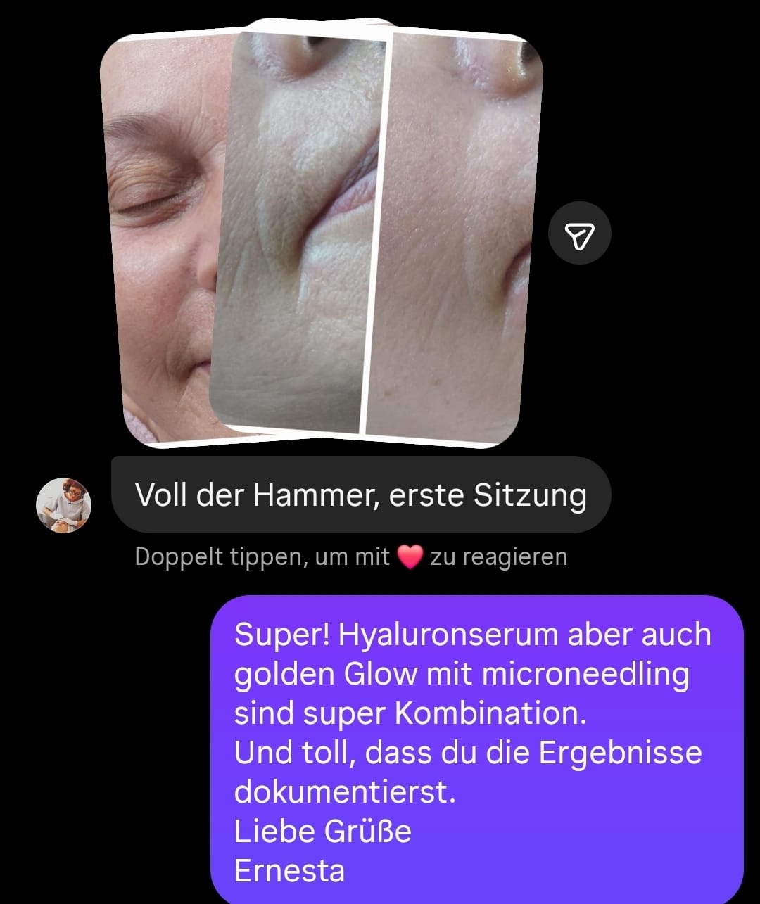 Microneedling Online Schulungsvideo mit Zertifikat