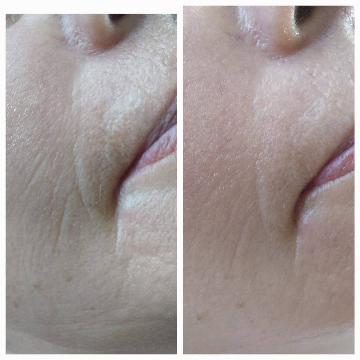 Microneedling Online Schulungsvideo mit Zertifikat