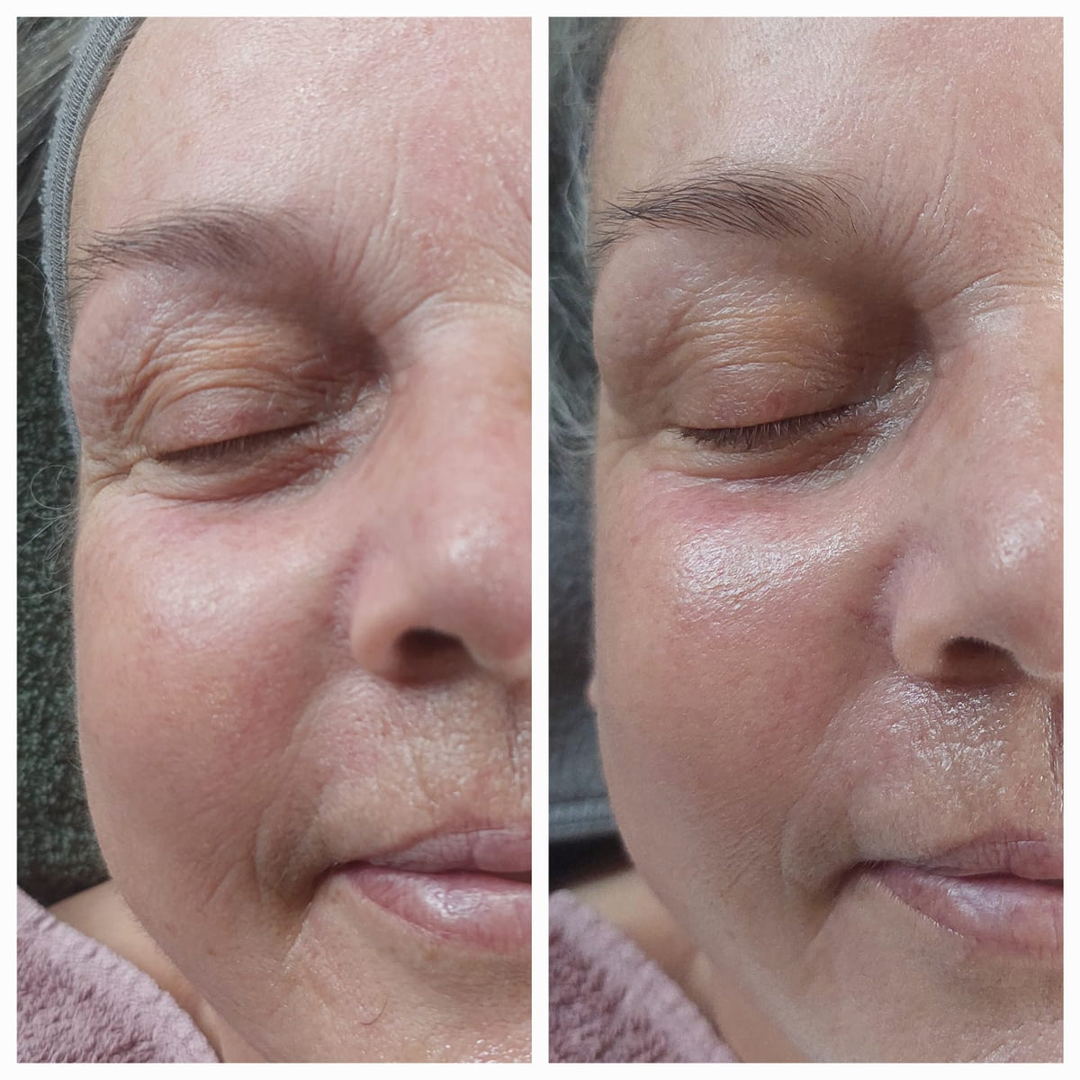 Microneedling Online Schulungsvideo mit Zertifikat