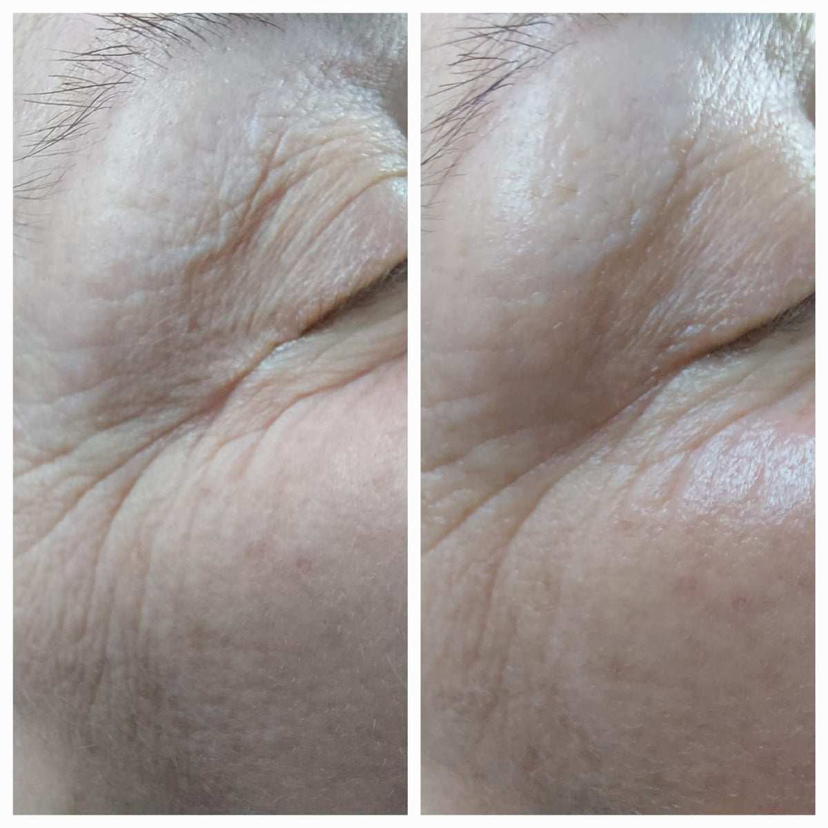 Microneedling Online Schulungsvideo mit Zertifikat